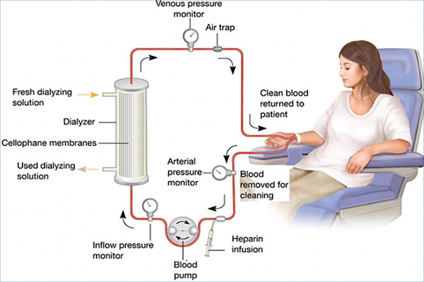 What Is Dialysis NephroPlus